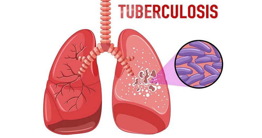 tuberkulez 1